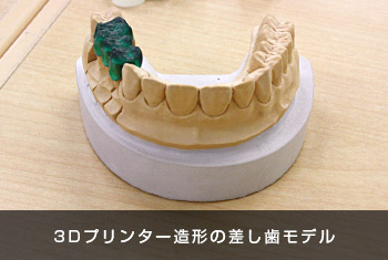3Dプリンター造形の差し歯モデル